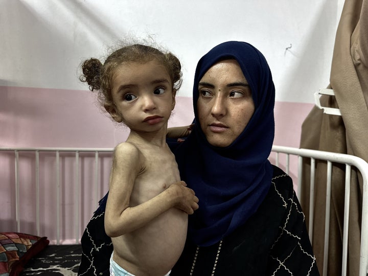 Mayar El-Arca, 18 months, receives treatment for severe acute malnutrition at Nasser Hospital in Khan Younus, Gaza on May 17, 2025.