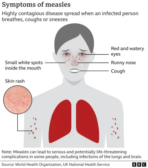 A graphic showing the symptoms of measles 