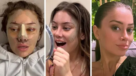 @hotgirlenhancements A composite image showing Emily, a woman with long brown hair, in recovery, smiling into a mirror with sticking plasters still on her face and after fully recovering with no bandages on