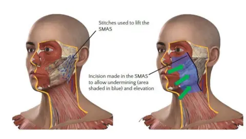 BAAPS A diagram showing how a facelift is carried out. There are two images of a face and neck with cross sections showing under the skin This diagram shows how surgeons cut under several layers before reaching the deep plane which they reshape