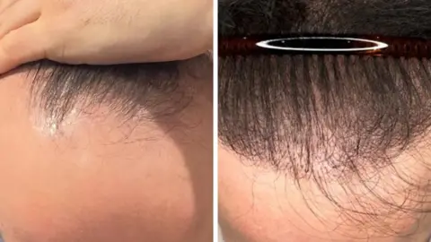 Ben Placito Ben Placito hair transplant, before and after procedure