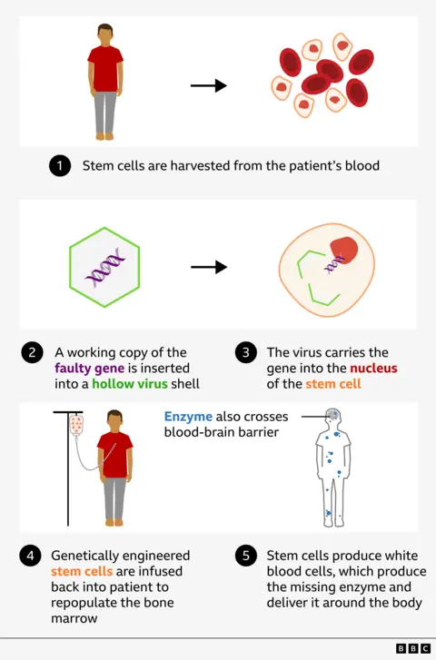 Graphic showing how genes are tweaked to treat Hunter syndrome
1. Stem cells are harvested from the patient's blood
2. A working copy of the faulty gene is inserted into a hollow virus shell
3. The virus carries the gene into the nucleus of the stem cell
4. Genetically engineered stem cells are infused back into patient to repopulate the bone marrow
5. Stem cells produce white blood cells, which produce the missing enzyme and deliver it around the body