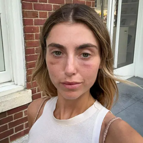 Charlotte Bickley Charlotte Bickley is wearing a white vest. She has long light brown hair and she has dark circles just above her cheek bones under her eyes 