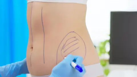 Getty Images A clinician wearing blue gloves draws surgical markings on a woman’s abdomen and waist in preparation for a cosmetic procedure, with blue privacy screens in the background.