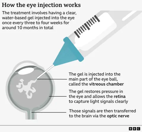 A graphic explaining how the eye injection treatment works. It shows a syringe positioned above an eyeball, with the needle entering the eye. A cutaway diagram of the eye labels the vitreous chamber as the area where a clear, water‑based gel is injected. Additional labels explain that the gel restores pressure inside the eye, helping the retina, lining the back of the eye, capture light signals clearly. The diagram also notes that these signals travel along the optic nerve to the brain. Text at the top states that the treatment involves injecting the gel every three to four weeks for about ten months.
