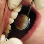 Patients of retired dentist warned of bloodborne viruses, including HIV