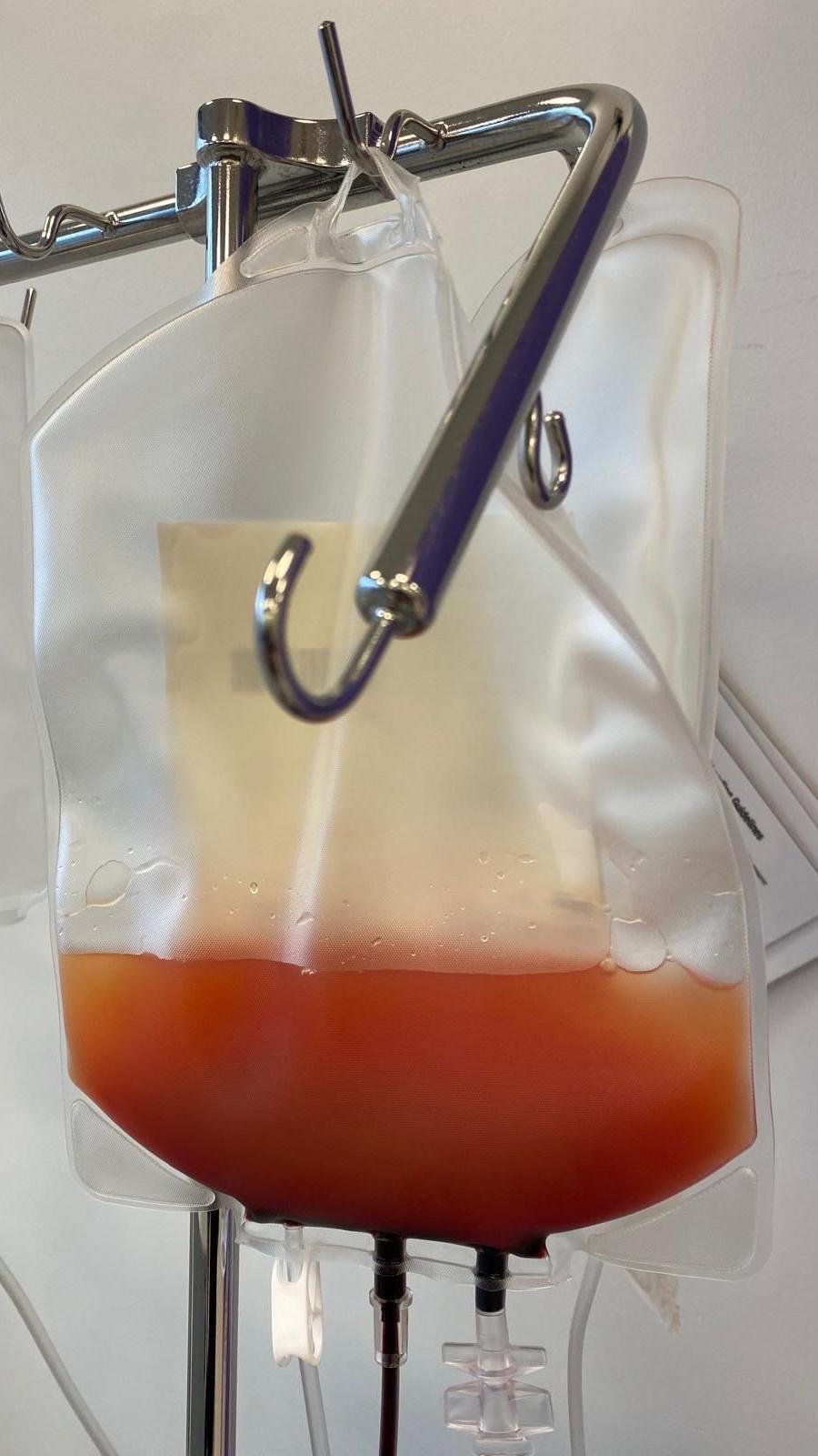 The image shows a close-up of a medical fluid bag hanging from a metal stand with several curved hooks. The transparent bag contains a deep reddish liquid pooled in the lower half, with condensation droplets visible on the inside surface. At the bottom of the bag, there are two outlet tubes connected, with the liquid visible inside one of them. The stand is made of shiny metal with multiple arms designed to hold equipment securely in place. The background is plain and clinical, suggesting a healthcare environment such as a hospital or treatment room.