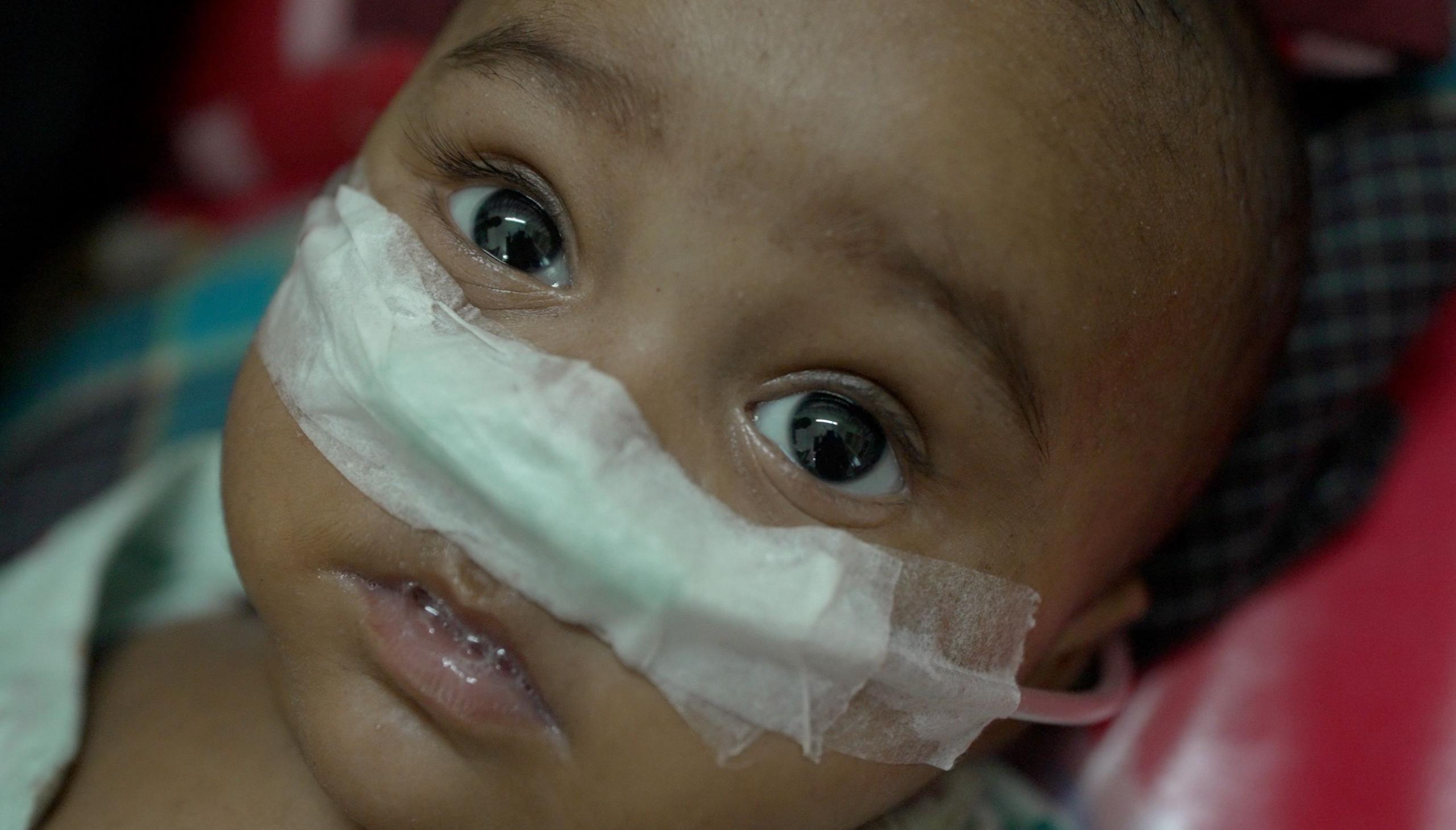 Close-up of a young Bangladeshi child lying down with a feeding tube secured across his nose with white medical tape