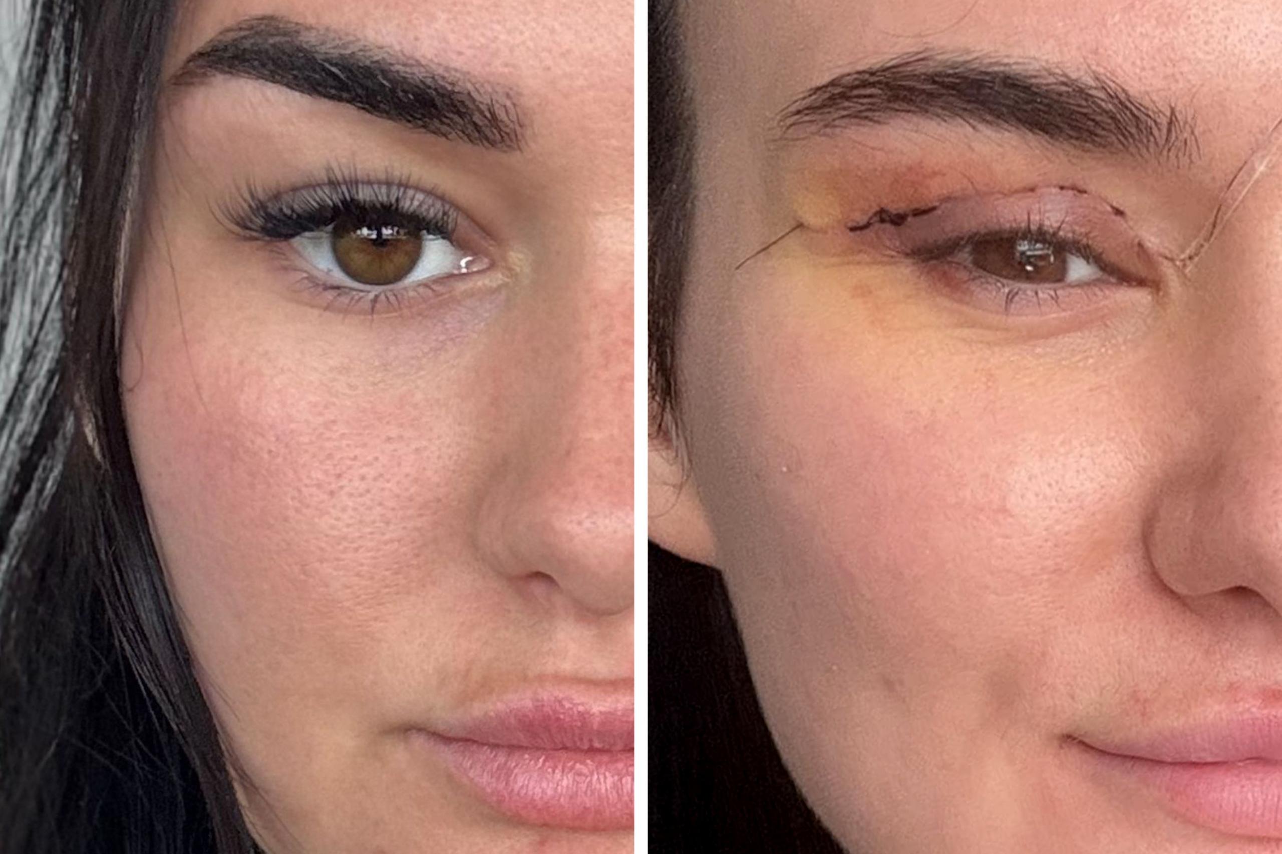 Side‑by‑side close‑ups of the same eye, showing a healthy eyelid on the left and a post‑surgical eyelid on the right with visible sutures and bruising.