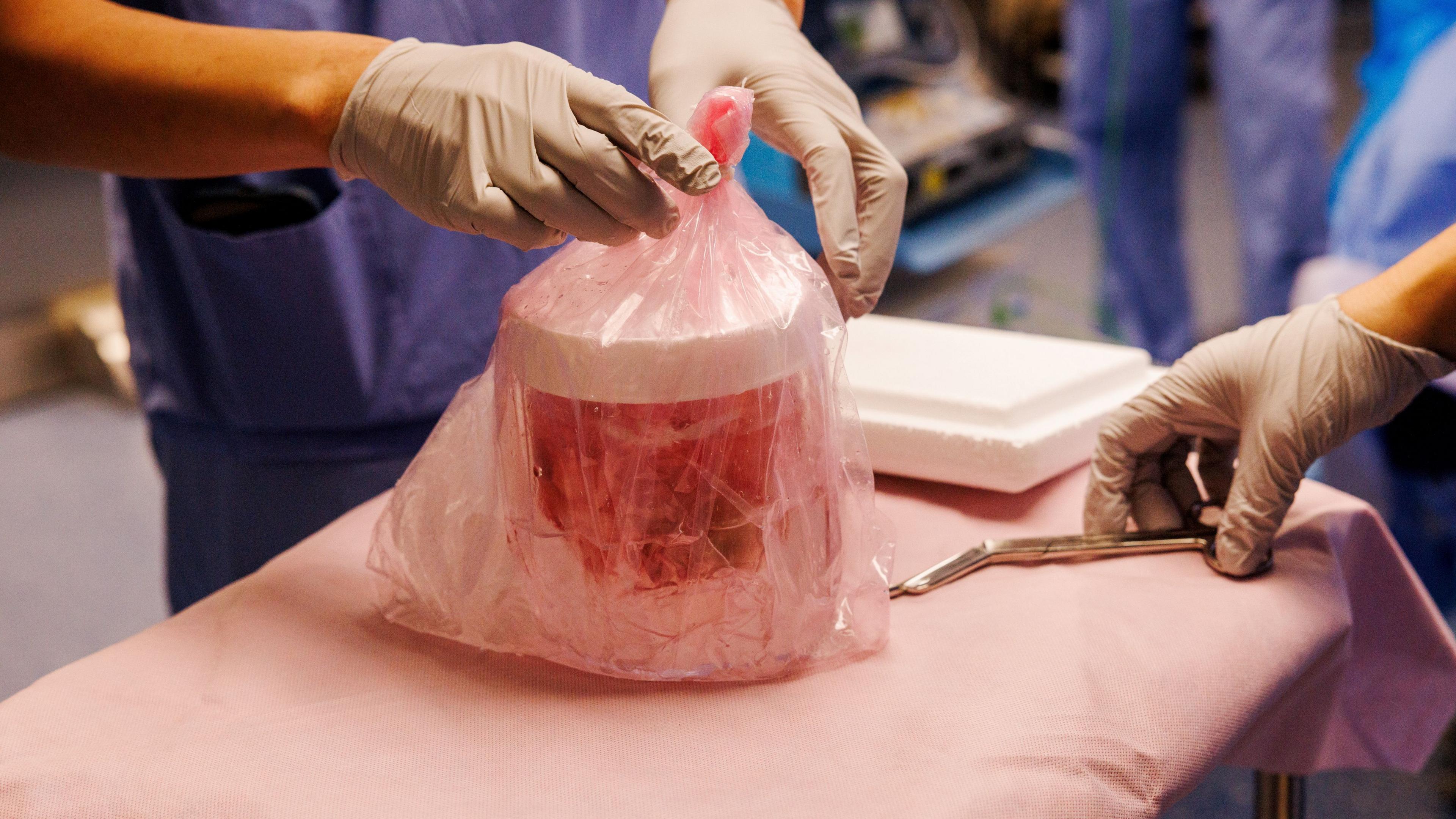 A close-up view shows gloved hands handling a translucent pink plastic bag on a covered medical table. Inside the bag is a cylindrical container holding red fluid, with a white lid visible near the top. Another gloved hand reaches toward a metal surgical instrument resting on the edge of the table. The background is softly out of focus, revealing a clinical environment with people in blue medical scrubs and equipment. 