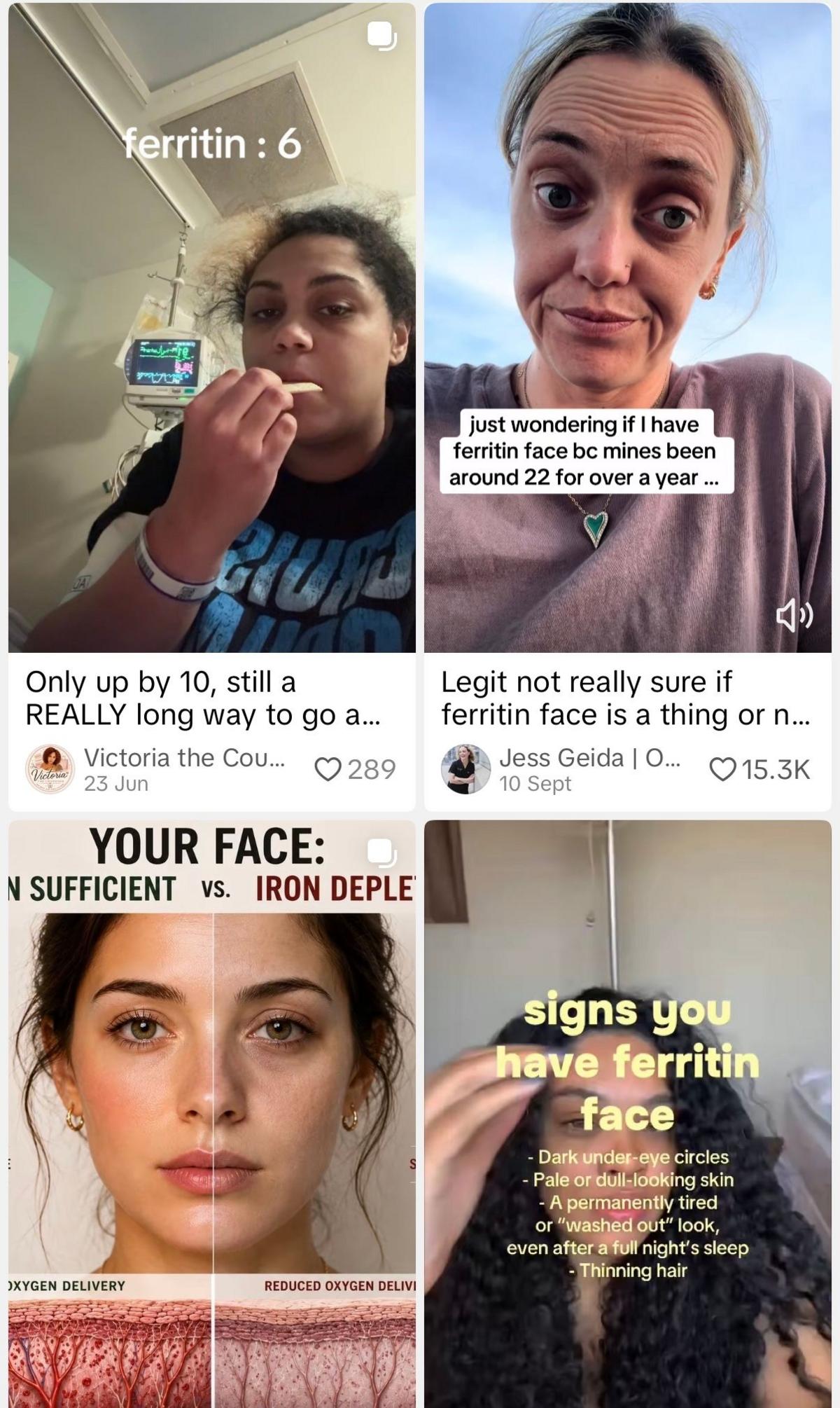 A collage of four social media posts about “ferritin face” from a search of the hashtag on Tiktok. The posts show women discussing low ferritin levels, before-and-after facial comparisons and lists of claimed signs including dark under-eye circles, pale or dull-looking skin, tiredness and thinning hair.