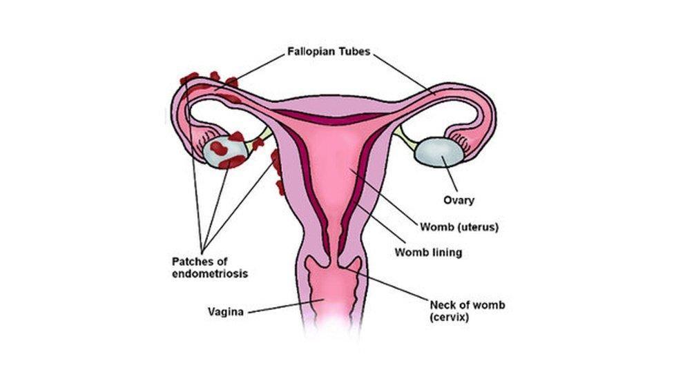 A drawing of female reproductive anatomy, with labels identifying an ovary, the womb, womb lining, neck of womb, vagina, and patches of endometriosis.