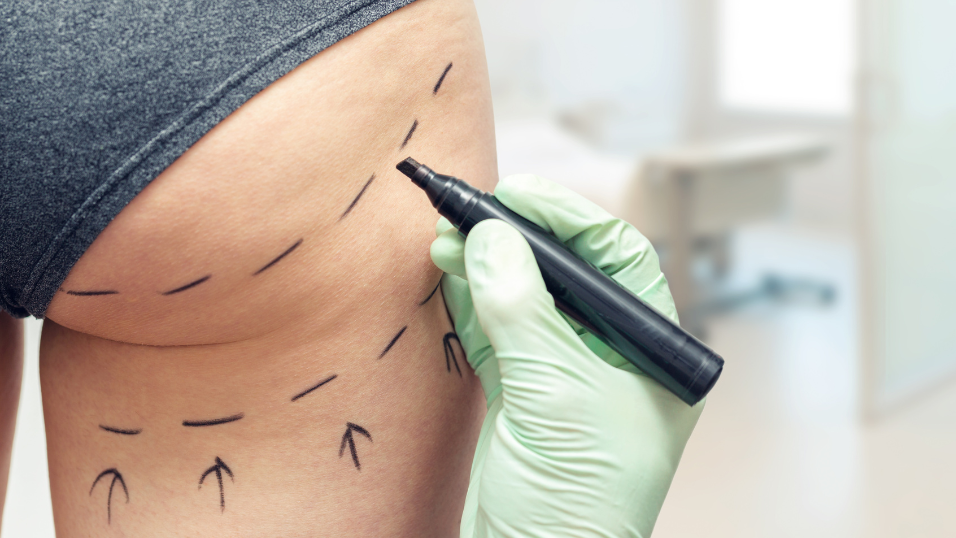 Woman getting skin marked for Brazilian butt lift